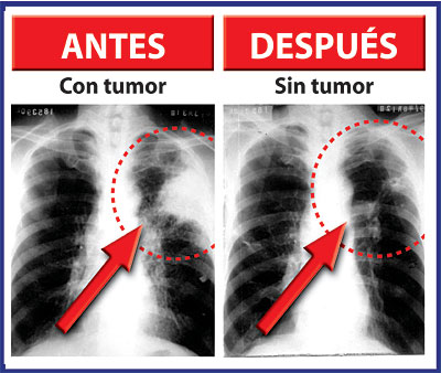 D�a Mundial contra el C�ncer - 2011